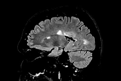 Brain - White matter lesions