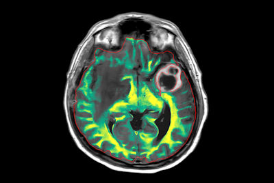 Large lesion brain imaging with synthetic MRI