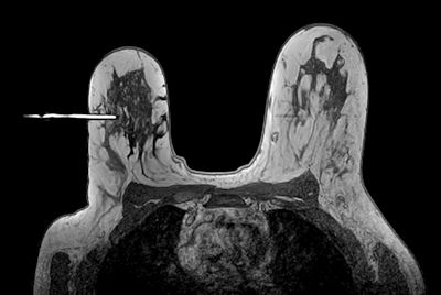 Breast biopsy with dS Sentinelle Breast coil