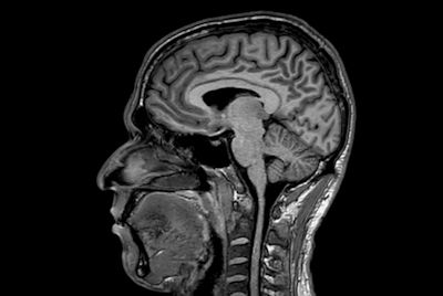 Alzheimer’s Disease Anti-Amyloid Immunotherapies (ARIA) 1.5T