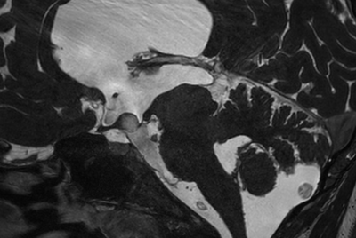 Pediatric Brain imaging for glioma