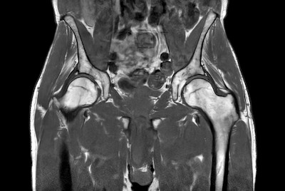 Fast bilateral hips, with SmartSpeed Precise