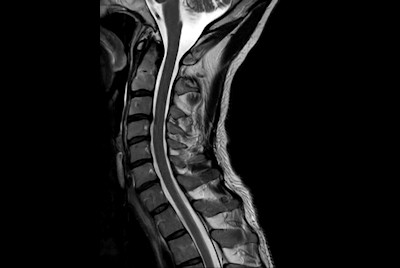 High quality Cervical Spine imaging with SmartSpeed Precise