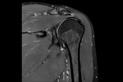 High quality Shoulder imaging with SmartSpeed Precise