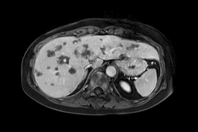 Liver metastasis with SmartSpeed Precise