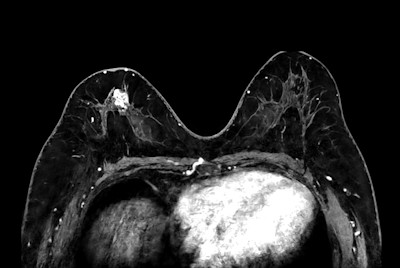 High quality Breast imaging with SmartSpeed Precise