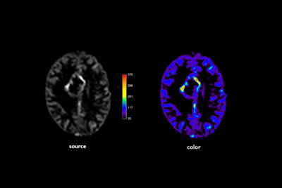 Advanced Neuro imaging - pCASL