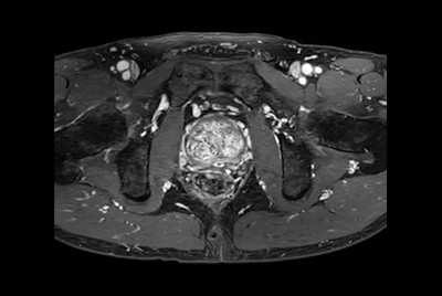 Fast Prostate imaging with SmartSpeed Precise
