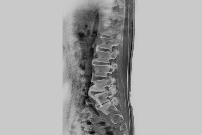 Lumbar Spine fracture with SmartSpeed Precise