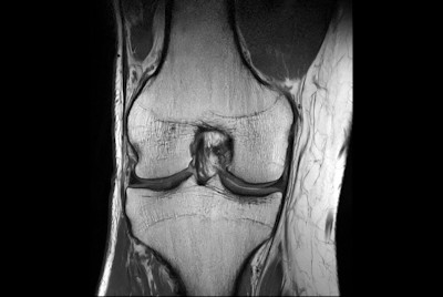Fast Knee imaging with SmartSpeed Precise