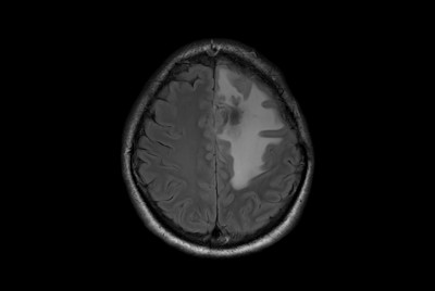 SmartSpeed Precise imaging for brain with glioblastoma