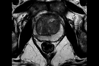 Prostate with the dS Torso coil at 3.0T