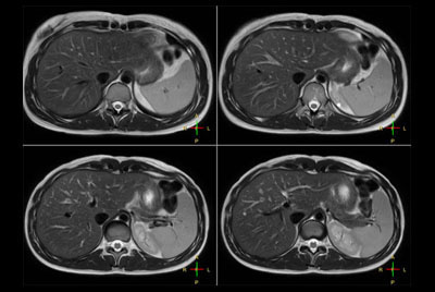 Liver imaging with MultiVane XD