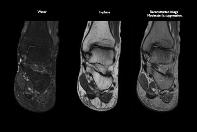 Orthopedic imaging with mDIXON XD TSE