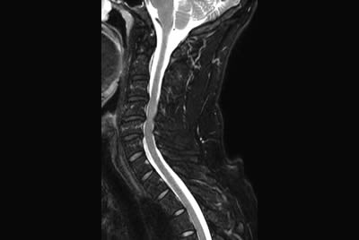 Cervical Spine with mDIXON XD