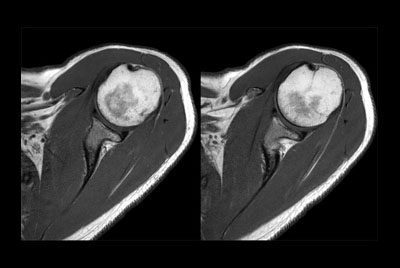 Shoulder imaging with dS Flex coil