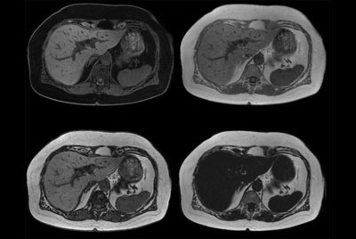 Liver imaging with MultiTransmit