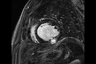 Cardiac infarction with Compressed SENSE