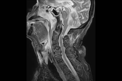 Cervical Spine - Cord lesion
