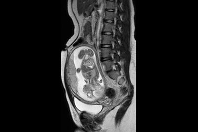 Appendicitis in pregnant patient