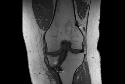 Metal Imaging of the Knee