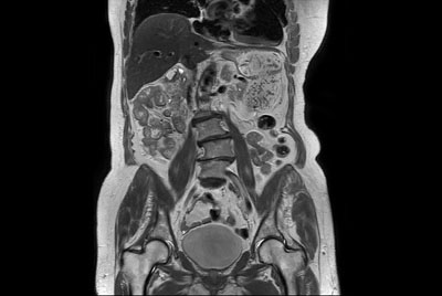 Total Torso imaging - High dS SENSE acceleration