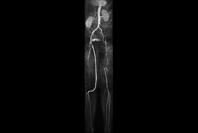 MR Angiography (run-off)