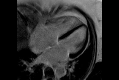 30 minute Cardiac Function and Fibrosis at 1.5T