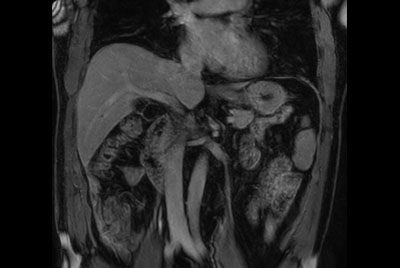 dS SENSE in Liver imaging