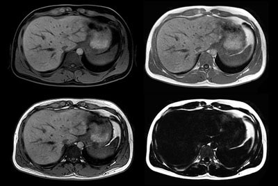 Comprehensive Liver imaging at 1.5T
