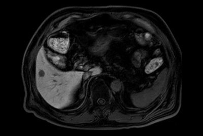 Liver MR imaging