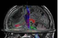Advanced imaging of the Brain