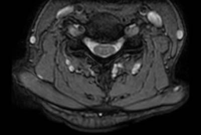 Cervical Spine with acoustic noise reduction