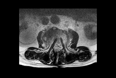 Lumbar Spine with metal suppression