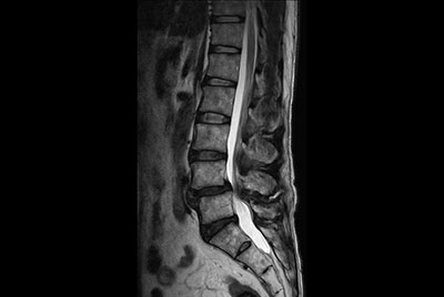Lumbar Spine disc herniation