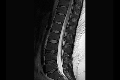 Lumbar Spine in obese patient - Qscan